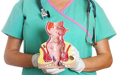 Nurse Holding Figure of Hemorrhoids