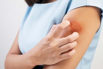 Woman with Ringworm