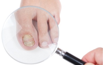 Magnifying Toenail Fungal Infection