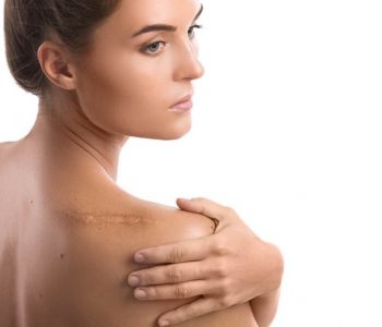 Tips for Preventing and Reducing Scars