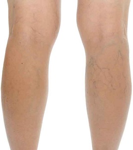 Legs with Varicose Veins